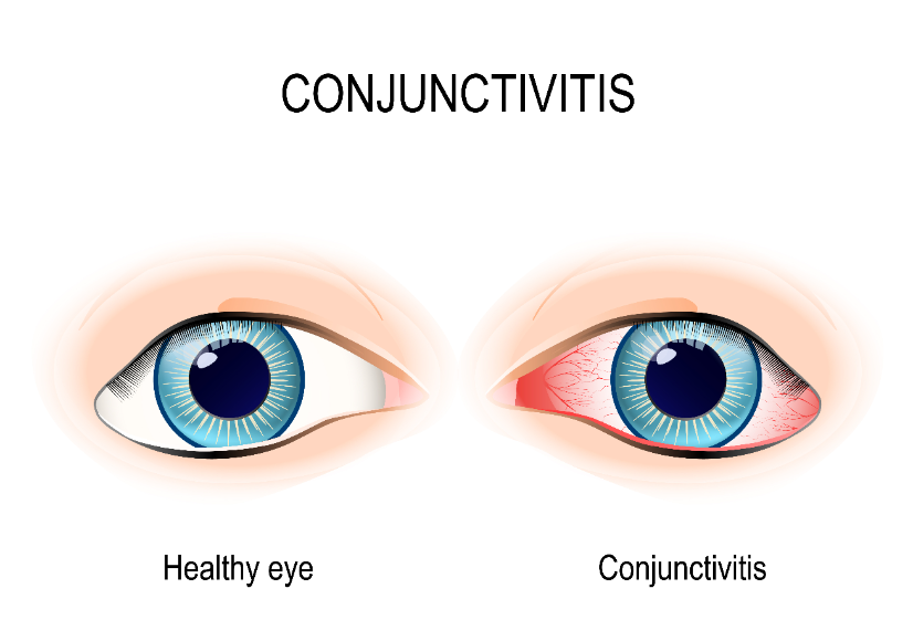 Soulager la conjonctivite avec l'homéopathie !